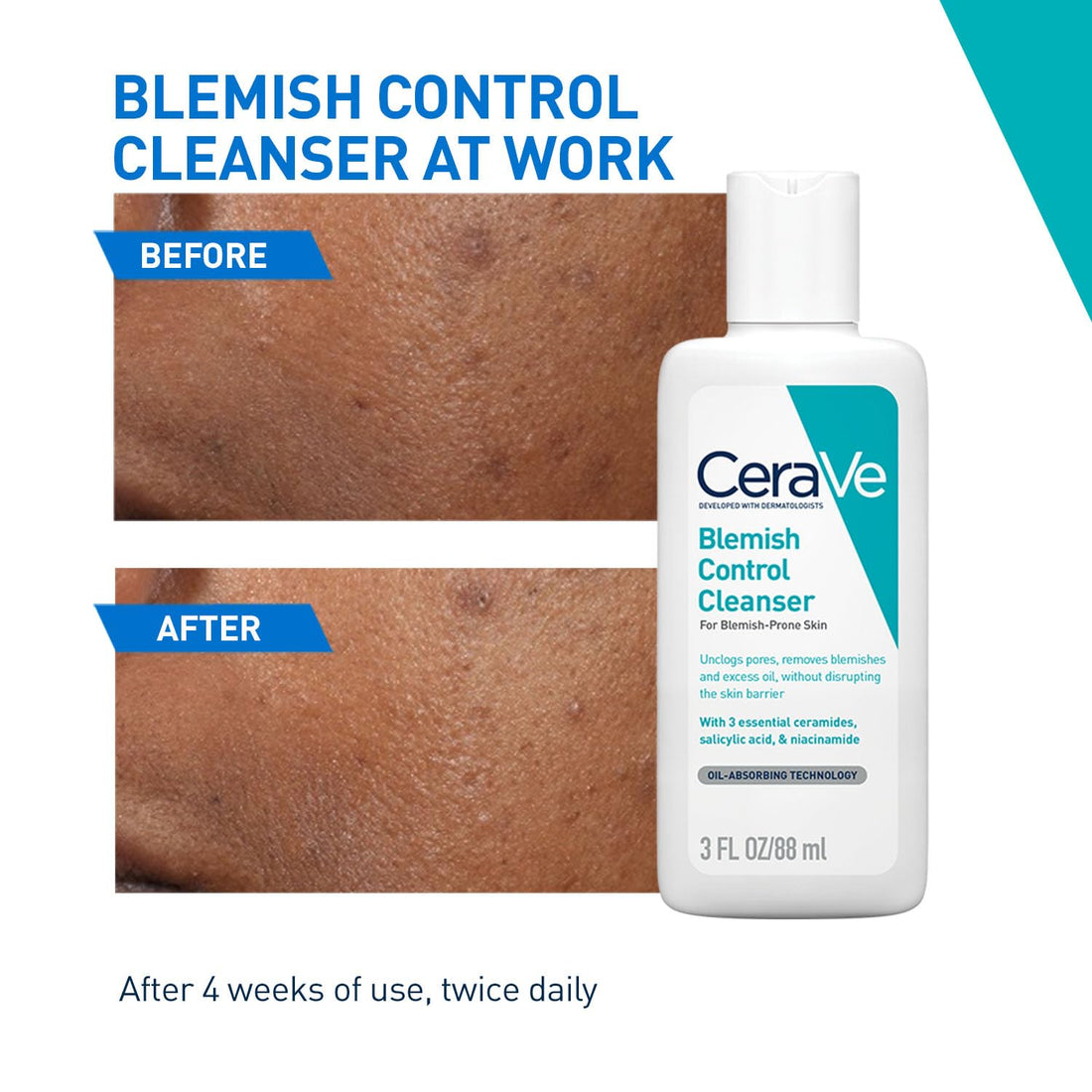 CeraVe Blemish Control Cleanser with 2% Salicylic Acid & Niacinamide for Acne Prone Skin, Controls Acne & Spots, Unclog Pores & Reduces Blemishes 88ml