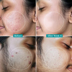 pilgrim 2% Salicylic Acid Anti-Acne Face Serum