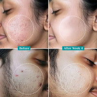 pilgrim 2% Salicylic Acid Anti-Acne Face Serum